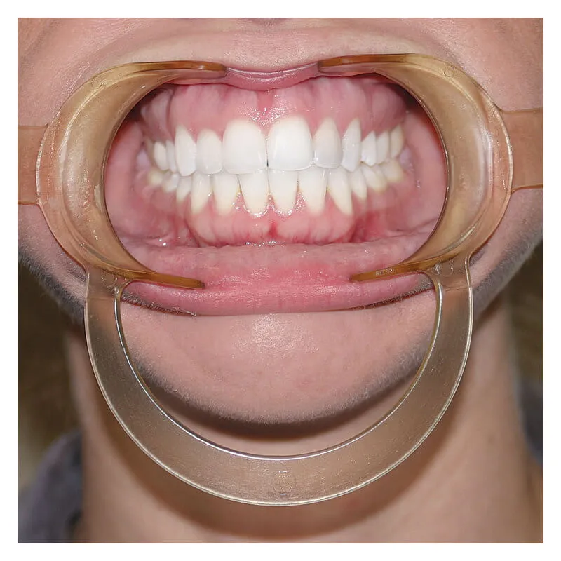 Retractor Extraoral Autoclavable, Child, Clear