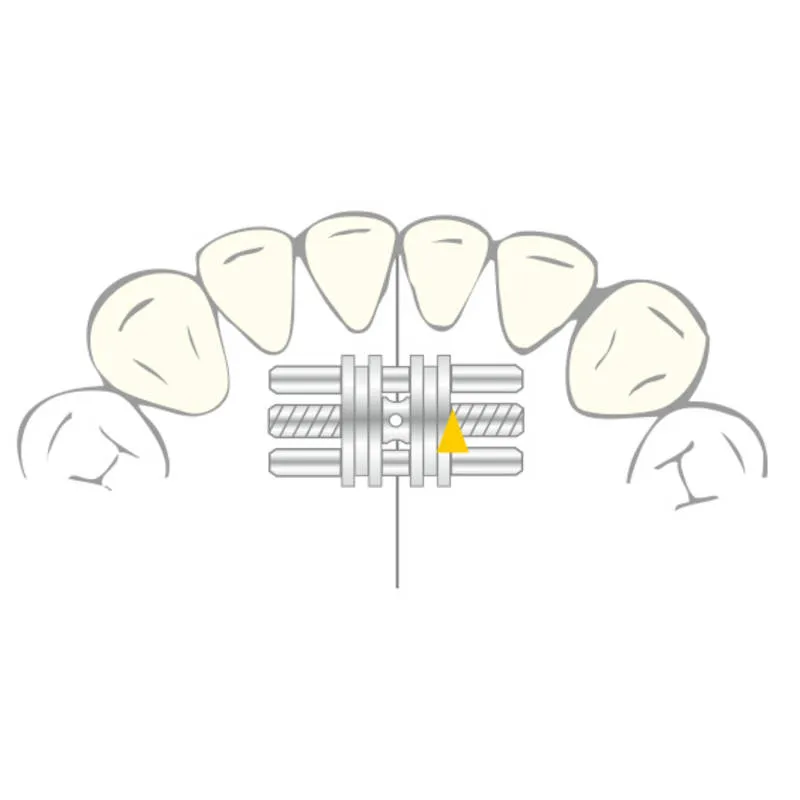VECTOR 90، موسعات هيكلية، 4mm، PK/10