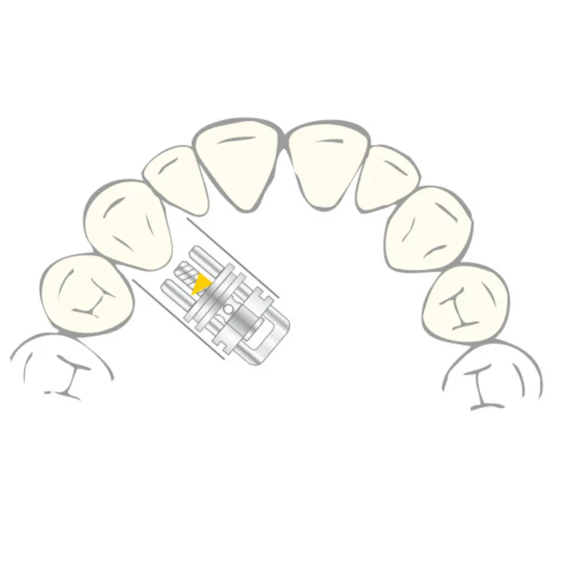 VECTOR 400, Skeletal Expanders, 3mm, PK/10
