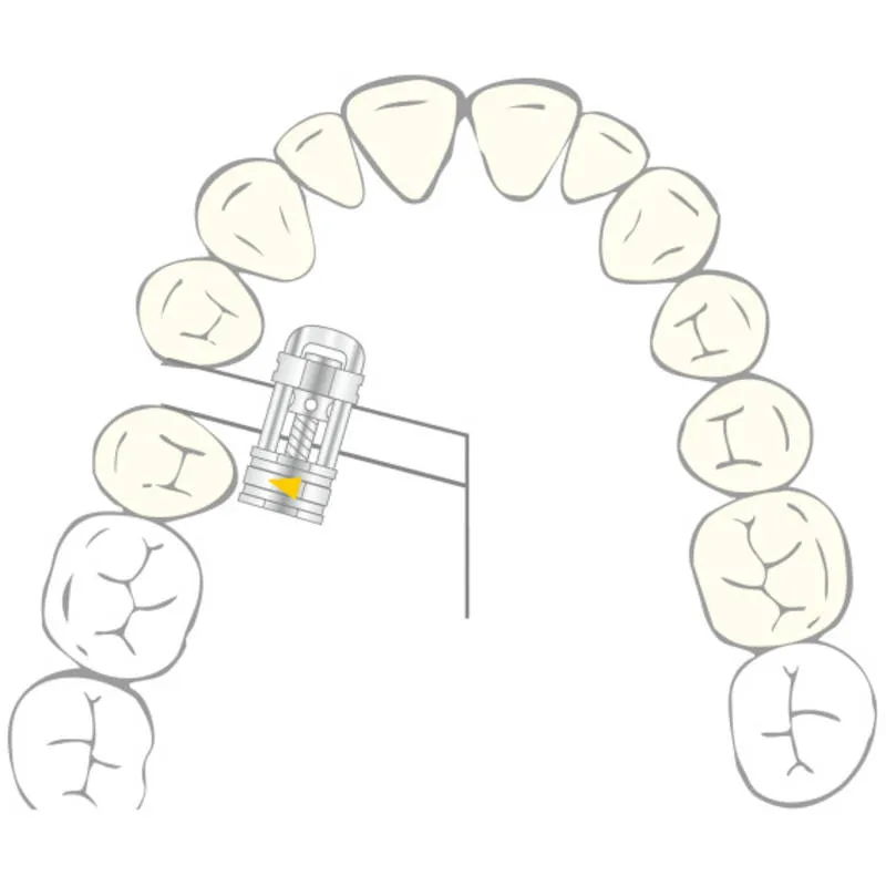 VECTOR 500, Skeletal Expanders, 3mm, PK/10